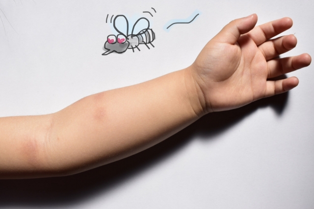 蚊に刺されて赤く腫れた子どもの腕と、イラストで描かれた蚊。かゆみや腫れの様子がわかる写真です。